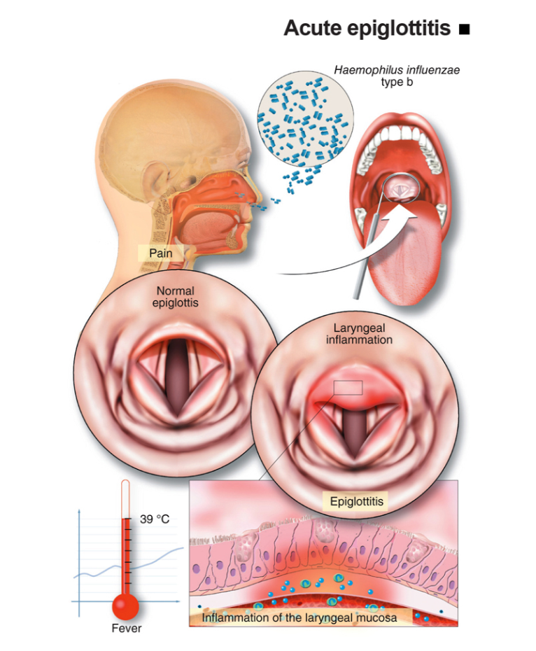 Infografis Acute Epiglottitis